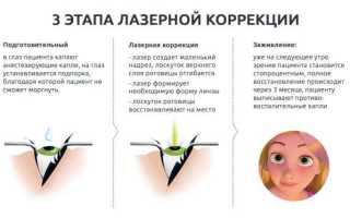 Коррекция глаз – противопоказания к лазерной операции для зрения и их влияние