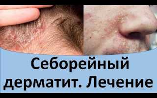 Диагностика и симптомы себорейного дерматита, лечение, видео