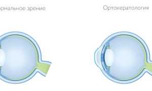 Ортокератология: ночные линзы для коррекции зрения