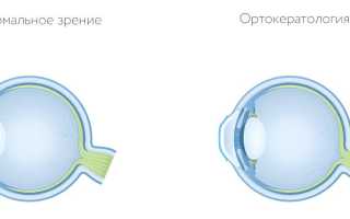 Ортокератология: ночные линзы для коррекции зрения