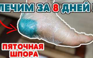 Шипы на пятках: симптомы и лечение, медицина и народные средства, видео