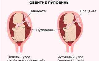 Опасен или нет узел пуповины при беременности: важные аспекты