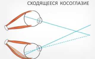 Можно ли исправить косоглазие? Узнайте все подробности