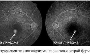 Центральная серозная хориоретинопатия: симптомы, причины, методы борьбы и профилактики