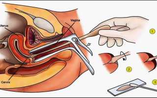 Зачем необходим бакпосев мазка при беременности для здоровья