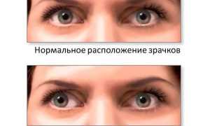 Почему косит один глаз – сходящееся и расходящееся косоглазие: причины и лечение