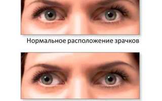 Почему косит один глаз – сходящееся и расходящееся косоглазие: причины и лечение