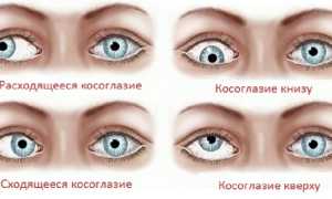 Лечится ли астигматизм – можно ли вылечить косоглазие, как и чем лечат, советы специалистов