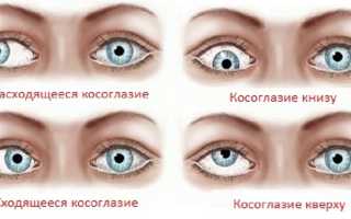Лечится ли астигматизм – можно ли вылечить косоглазие, как и чем лечат, советы специалистов