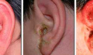 Отит наружного уха: диагностика и способы лечения