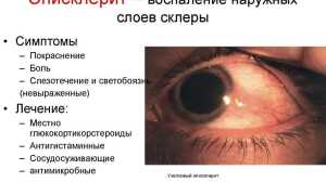 Эписклерит глаза: признаки, причины возникновения, лечение и профилактика