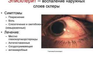 Эписклерит глаза: признаки, причины возникновения, лечение и профилактика