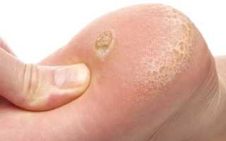 Лечение натоптышей на ногах: эффективные рецепты избавления. Видео советы