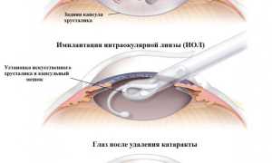 Лечение и профилактика вторичной катаракты после замены хрусталика: важные аспекты