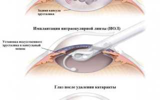 Лечение и профилактика вторичной катаракты после замены хрусталика: важные аспекты
