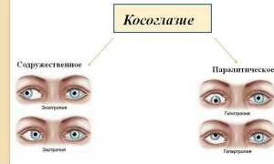 Содружественное косоглазие: причины, симптомы и лечение у взрослых