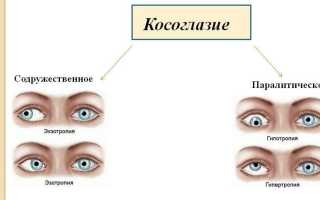 Содружественное косоглазие: причины, симптомы и лечение у взрослых