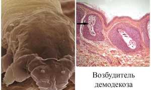 Симптомы и лечение демодекоза глаз: полезные советы и рекомендации