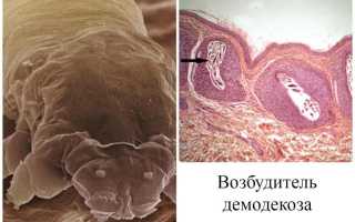 Симптомы и лечение демодекоза глаз: полезные советы и рекомендации