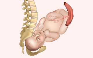 Роды при узком тазе: особенности и рекомендации