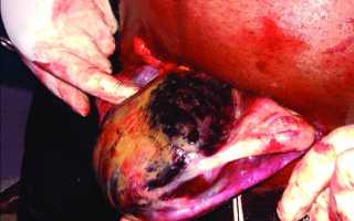 Матка Кувелера и беременность: что за патология, ее причины, чем опасна для здоровья