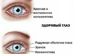 Красный глаз у ребенка – что делать и чем лечить покраснения, советы специалистов
