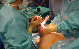 Кесарево — как проходит операция и ее особенности