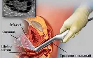 Цервикометрия: что это за процедура и в каких случаях она необходима для здоровья