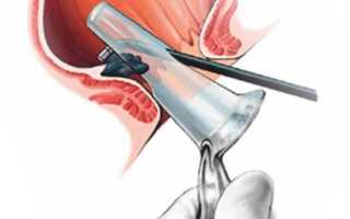 Инфракрасная коагуляция при беременности, что это и как применяется