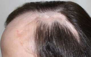 Лечение алопеции во время беременности: советы и рекомендации