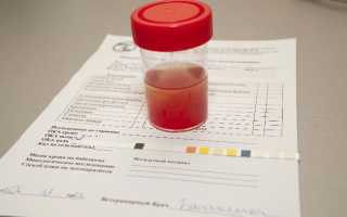 О чем говорит кровь в моче при беременности: важные аспекты здоровья