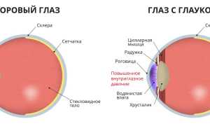 Катаракта и глаукома – что хуже и страшнее на ранних стадиях, признаки и симптомы, их влияние на зрение