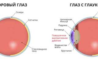 Катаракта и глаукома – что хуже и страшнее на ранних стадиях, признаки и симптомы, их влияние на зрение