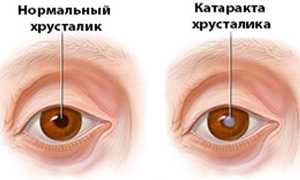 Катаракта: операция и реабилитация для восстановления зрения