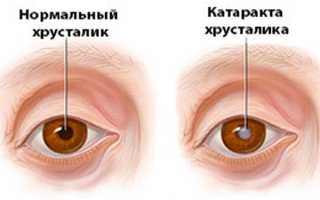 Катаракта: операция и реабилитация для восстановления зрения
