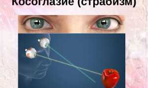 Косоглазие у новорожденных: методы лечения, последствия развития болезни и советы по уходу