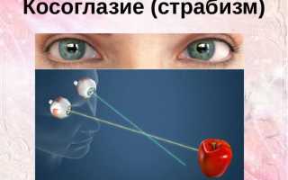Косоглазие у новорожденных: методы лечения, последствия развития болезни и советы по уходу