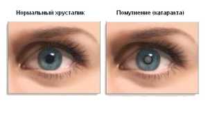 Катаракта: лечение с помощью капель для улучшения зрения
