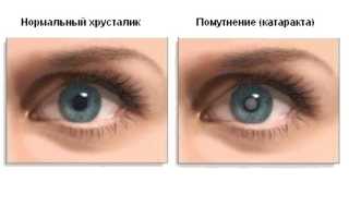 Катаракта: лечение с помощью капель для улучшения зрения