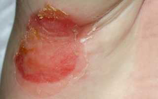 Лечение перианального кандидозного дерматита