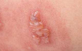 Герпес при беременности: причины и последствия