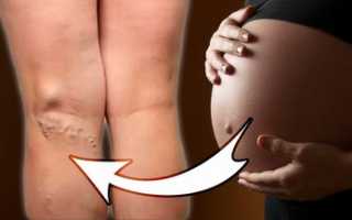 Совместимы ли тромбоз сосудов и беременность в современных исследованиях