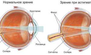 Астигматизм – особенности заболевания и методы лечения глаз
