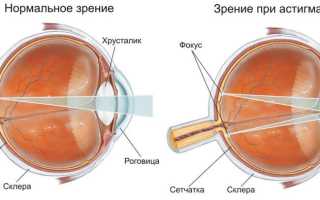 Астигматизм – особенности заболевания и методы лечения глаз