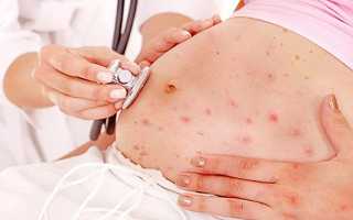Чем опасна ветрянка при беременности для здоровья матери и ребенка