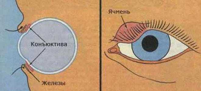 Ячмень на глазу: причины появления и методы лечения для здоровья глаз