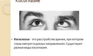 Особенности лечения косоглазия у детей: важные аспекты и рекомендации