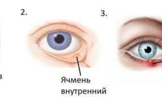 Ячмень на глазу и его лечение: советы и рекомендации