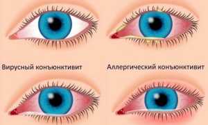 Конъюнктивит – неприятное заболевание грудничков, требующее внимания