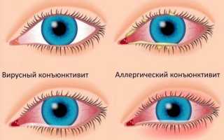 Конъюнктивит – неприятное заболевание грудничков, требующее внимания